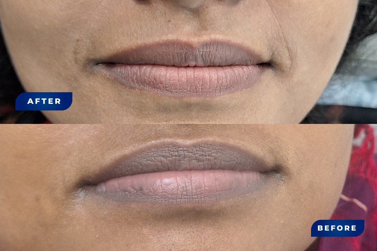 Dark Lip Correction